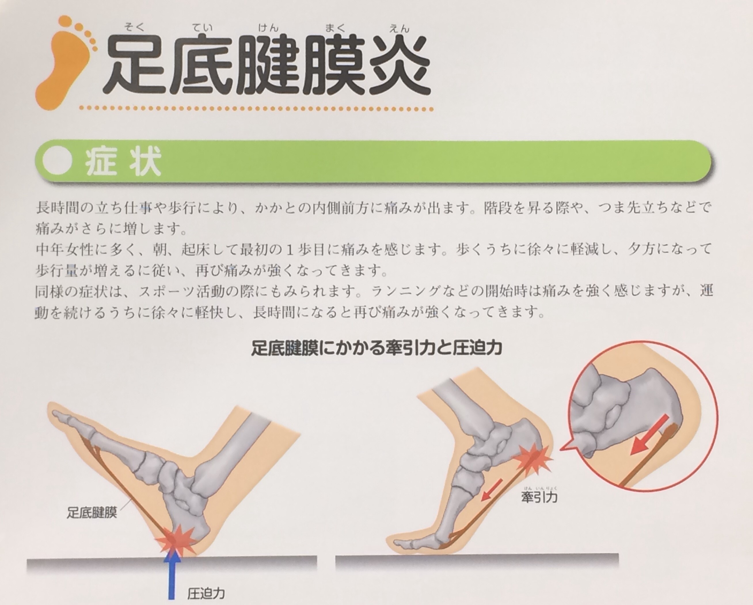 かかと が 痛い 左足 かかとのしびれの原因を調査｜手足のしびれをケース別に分析